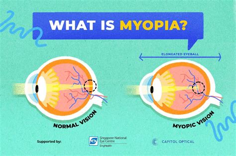 SuperVision Launches Campaign to Prevent Progression of Childhood Myopia | BubbaMama.com