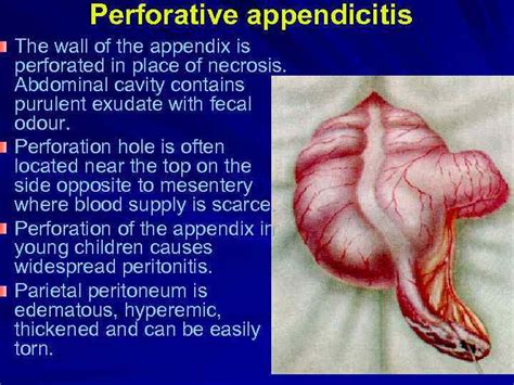 Lecture on pediatric surgery for the 5 -th