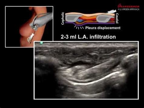 ULTRASOUND GUIDED INTERCOSTAL NERVE BLOCK - YouTube