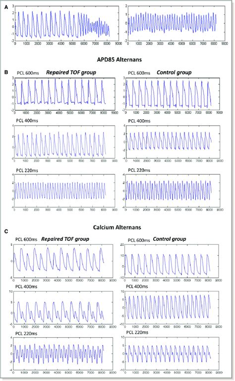 Polymorphic Ventricular Tachycardia Causes