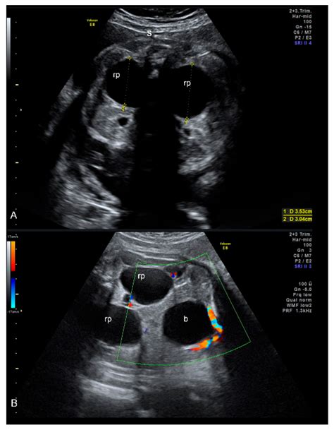 Reprod. Med. | Free Full-Text | Prenatal Diagnosis of Severe Fetal ...