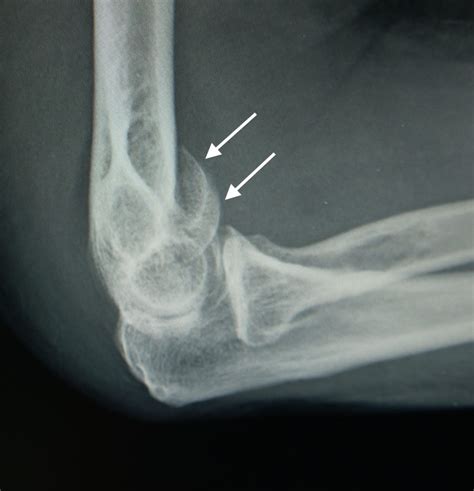 Humeral Fracture Screws at John Willard blog