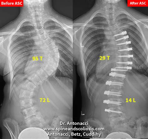 PT 12y/o - 95 Thoracic Before After ASC Double Curve Scoliosis Surgery ...