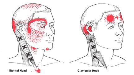 Sternocleidomastoid Muscle Exercises