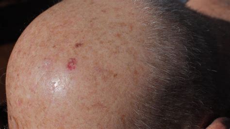 Skin Cancer on Scalp: Symptoms, Diagnosis, Treatment, and Prevention