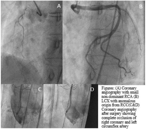 Use Of Temporary RVAD To Promote Right Ventricular Recovery After Acute ...