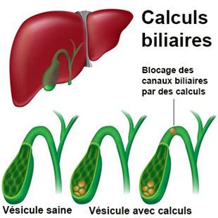 Maladies de la vésicule et des voies biliaires : définition - docteurclic.com