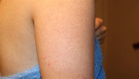 Here’s the reason you are getting red bumps on your arms | Nova 100