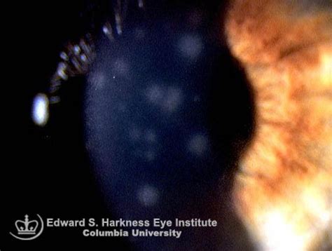 Epidemic Keratoconjunctivitis | Vagelos College of Physicians and Surgeons