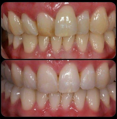 Teeth Straightening Edinburgh, Leith | Braces | Teeth Straightening Cost