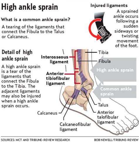 The High Ankle Sprain