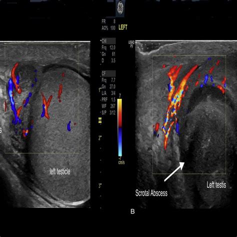 a. Initial doppler ultrasound showing enlarged left epididymis with... | Download Scientific Diagram