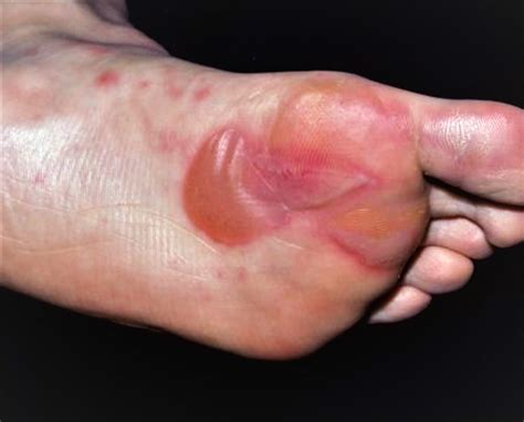 Blister on Foot - Causes and How To Treat Foot Blisters