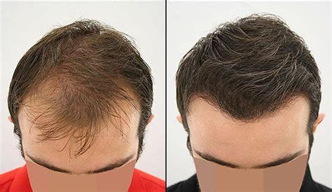 Hair transplant in Iran| The success rate of Hair transplant in men & women