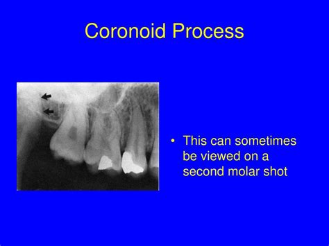 PPT - RADIOGRAPHIC INTERPRETATION PowerPoint Presentation, free ...