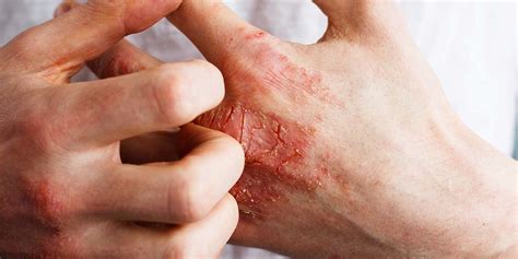 Krokodil Drug Effects | Drug Addiction Florida | Addiction