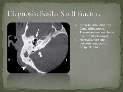 Basal Skull Fracture Signs