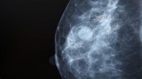 Breast Density and Breast Cancer Risk | Breast Cancer Prevention and Detection | University of ...