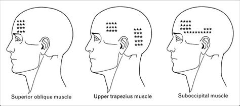 Suboccipital Muscles Trigger Points