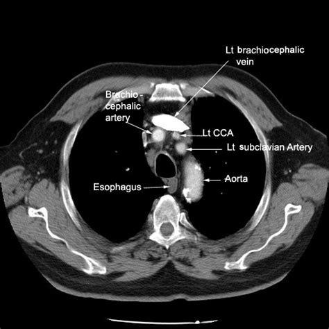 Identify the vascular structures. Click the image for labeling.