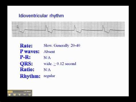 ECG: Idioventricular Rhythm - YouTube