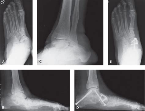 Triple Arthrodesis | Musculoskeletal Key