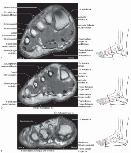 Mri Plantar Foot Anatomy Muscles