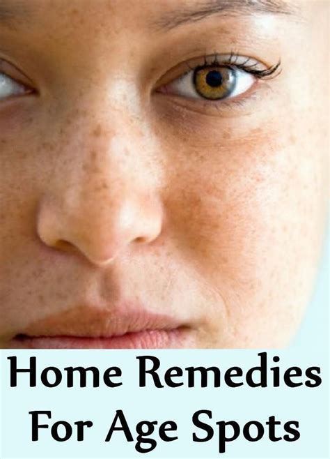 10 Home Remedies For Age Spots | Age spots, Home remedies, Remedies