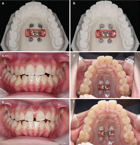 Bone-Anchored Rapid Palatal Expansion | Pocket Dentistry