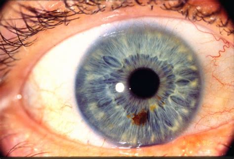 Iridology, Nutrition and Cognition Research