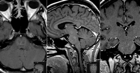 Radiology MRI: Central Pontine Myelinolysis