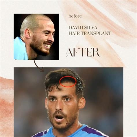 David Silva Hair Transplant: What the Expect