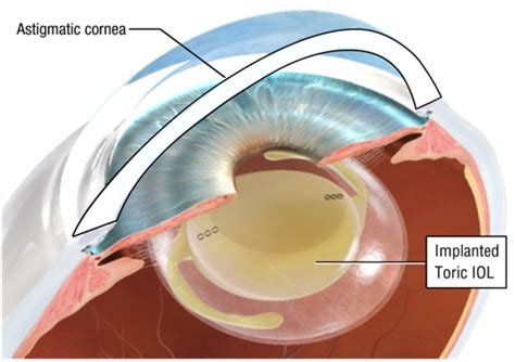 Refractive Lens Surgery - Tanner Eyes