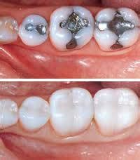 Porcelain Fillings | Natural Dentist Associates