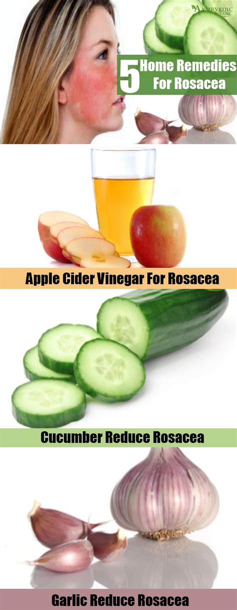 Top 5 Home Remedies For Rosacea - Natural Treatments And Cures | Herbal Supplements