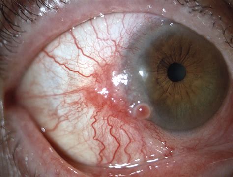 Conjunctival Cancer - MEDizzy Journal