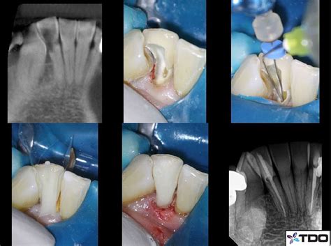 Extensive carious lesion. Pretty much the only remaining tooth structure is the lingual surface ...