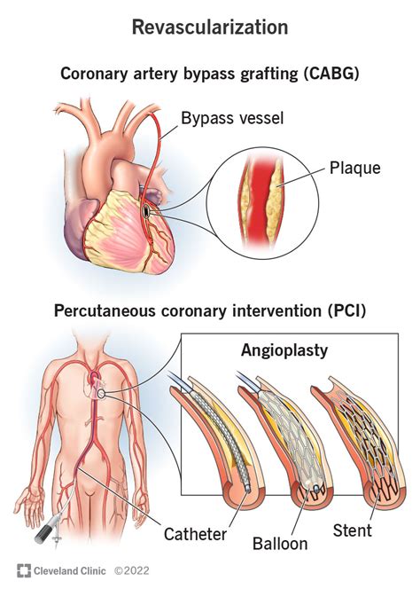 Coronary Revascularization: Procedure Details & Risks