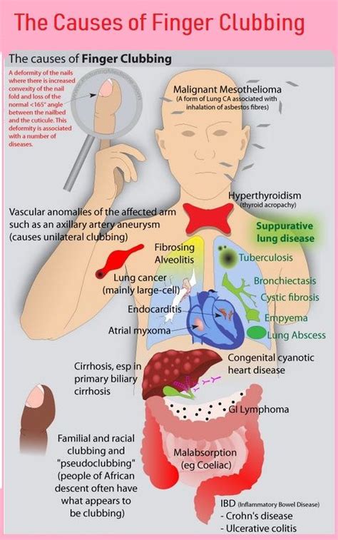 Causes of Finger Clubbing - Medical eStudy | Medical mnemonics ...