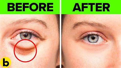 17 Easy Home Remedies To Get Rid Of Under Eye Bags - YouTube