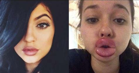 The Kylie Jenner Lip Challenge Has Turned Into A Complete Disaster (19 ...