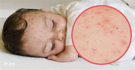 Chicken Pox Symptoms + How to Find Natural Relief - Dr. Axe