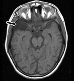 Arachnoid Cysts | Pediatric Neurosurgery | Dartmouth Health Children's