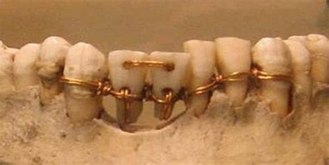 123 Dentist Presents: The History of Braces - 123Dentist