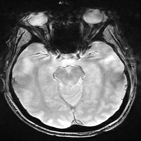 Cureus | Third Cranial Nerve Palsy Due to COVID-19 Infection