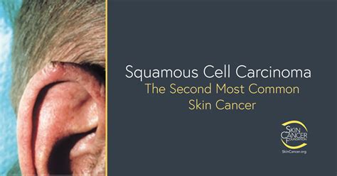 Early Squamous Cell Skin Cancer Signs