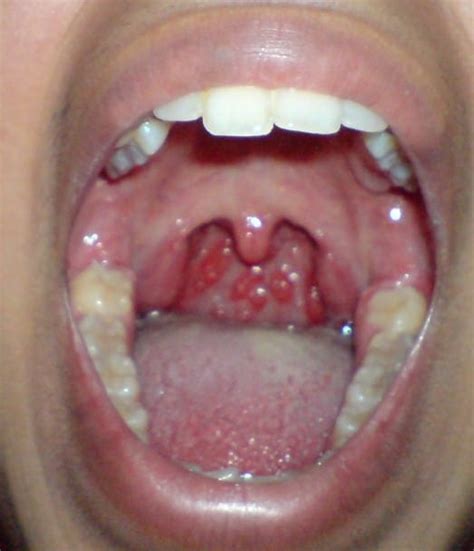 Sore Throat S2 Inflamed Throat Jpg Pictures to pin on Pinterest