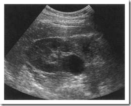 Ultrasound images Extrarenal pelvis of kidney - Radiology Imaging