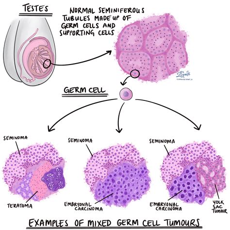 Mixed germ cell tumour of the testis - MyPathologyReport.ca