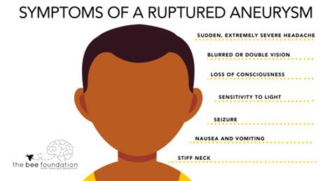 About Brain Aneurysms - The Bee Foundation